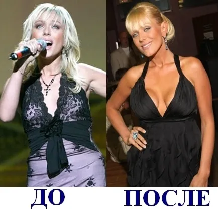 Юлия Началова до и после пластических операций