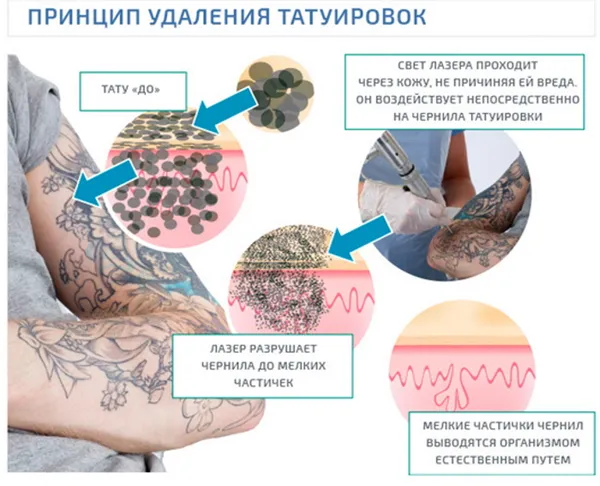 Как свести тату, удаление татуировки в домашних условиях
