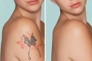 Как свести татуировку 