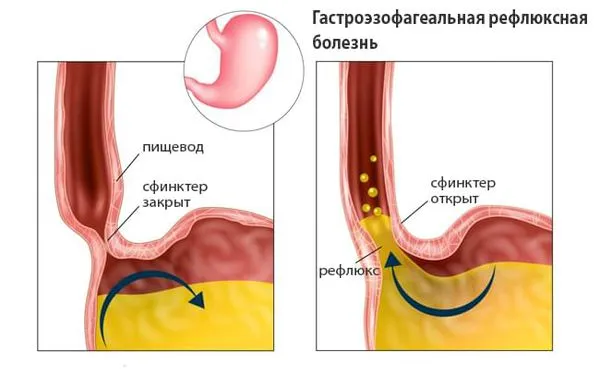 Разбился ртутный градусник в комнате с маленьким ребенком что делать 17