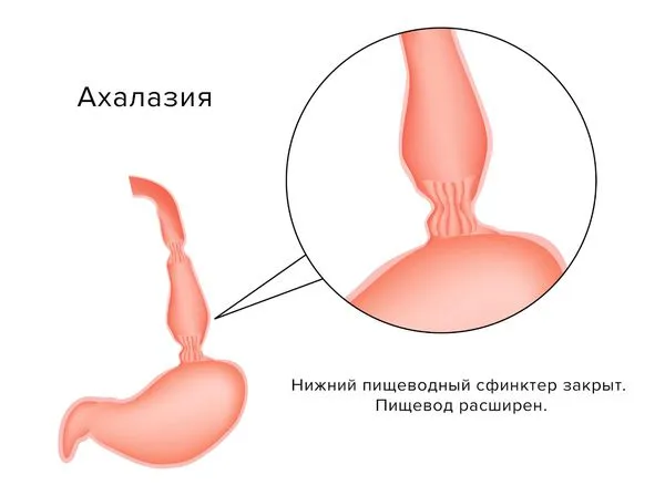 Ахалазия пищевода и кардии